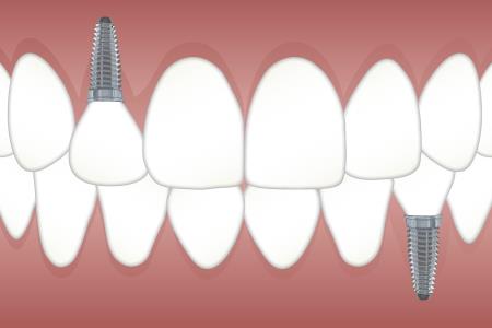 Ustno zdravje in ustna higiena pri osebah, ki nosijo proteze